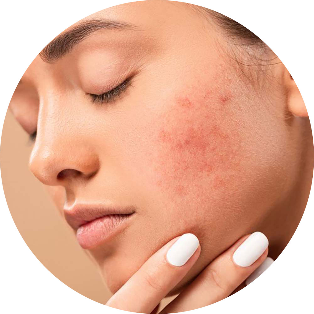 Acne-Treatment